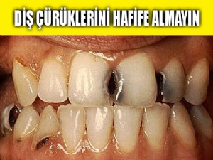 Diş çürüğü de hastalığa sebep olabiliyor