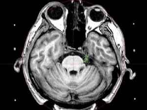 Gamma-Knife  etkin bir tedavi yöntemidir