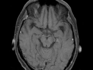 Tekli Beyin Tedavilerinde Gamma-Knife uygulaması